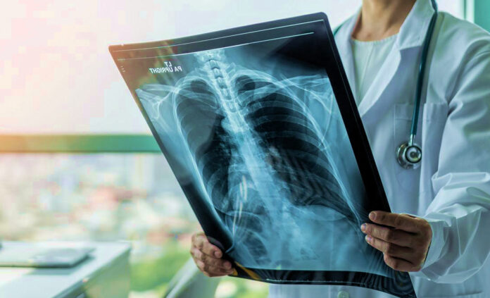 ASCO 2026: 2 νέες θεραπείες αλλάζουν τον καρκίνο πνεύμονα καρκίνος πνεύμονα